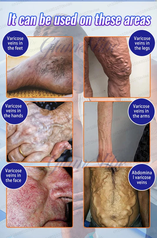 Leg Phototherapy Pen – Relieves Swelling, Heaviness & Promotes Circulation