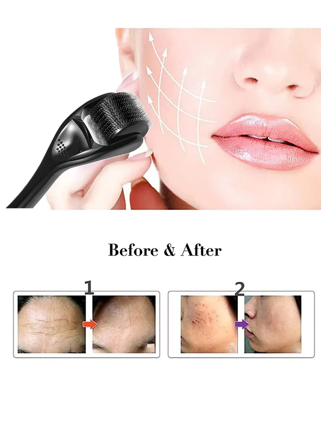 540-Pin Titanium Microneedle Derma Roller
